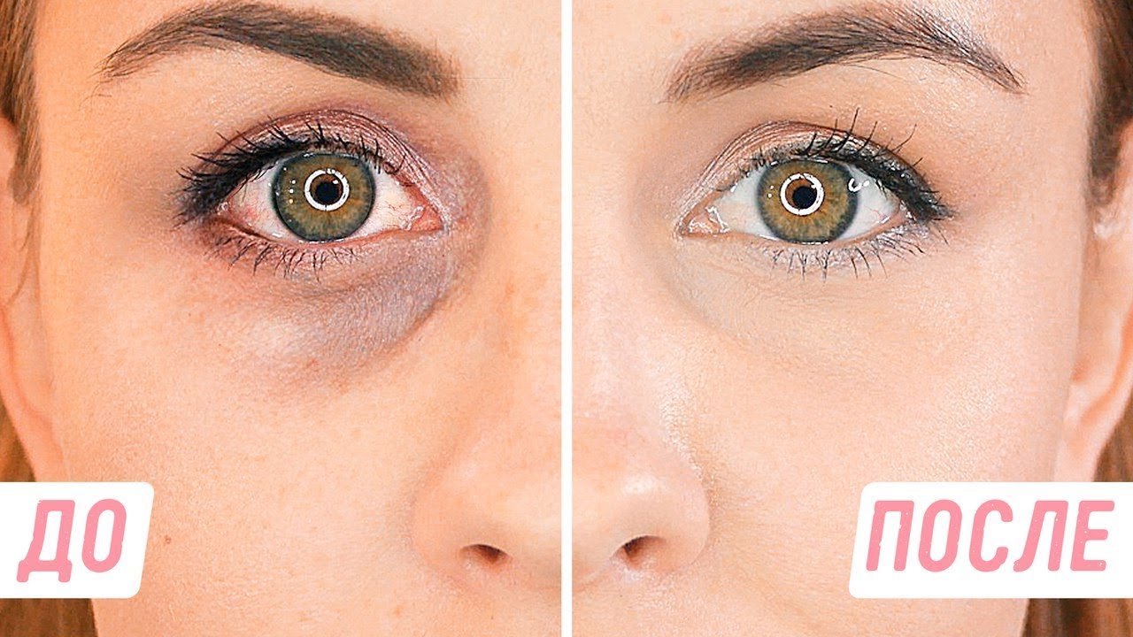 Как убрать мешки под глазами? Как убрать мешки под глазами?